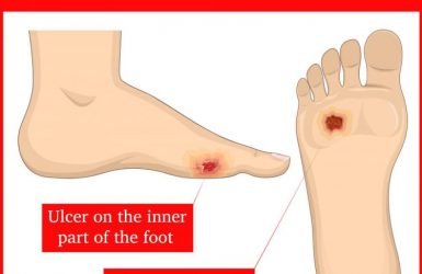 Foot Problems