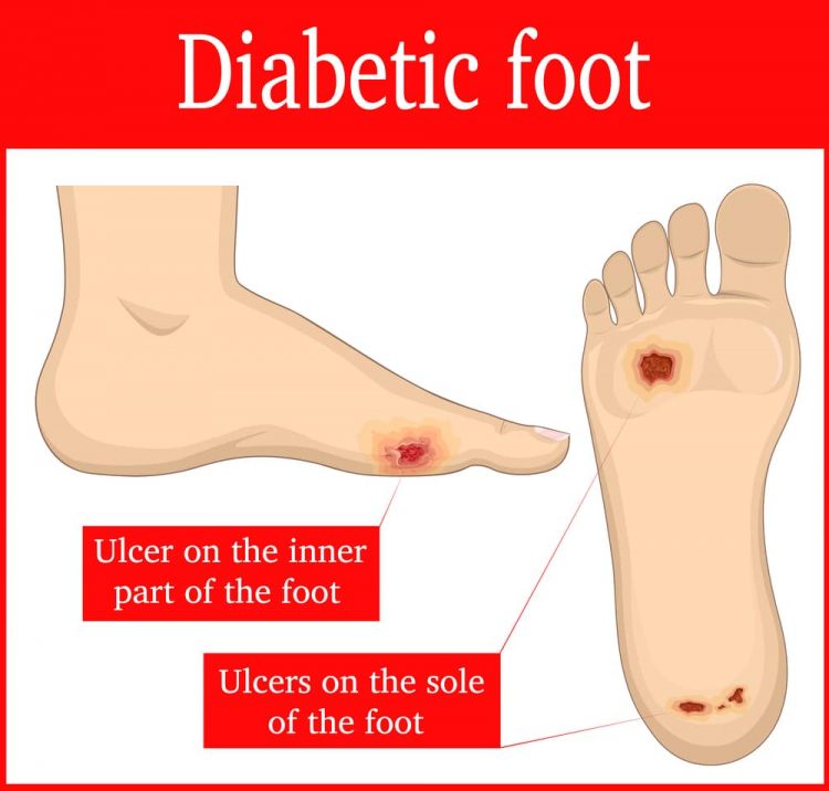 Foot Problems